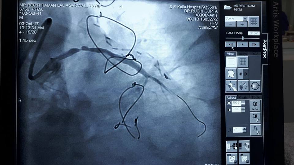 Rare Case Of Graft Angioplasty 